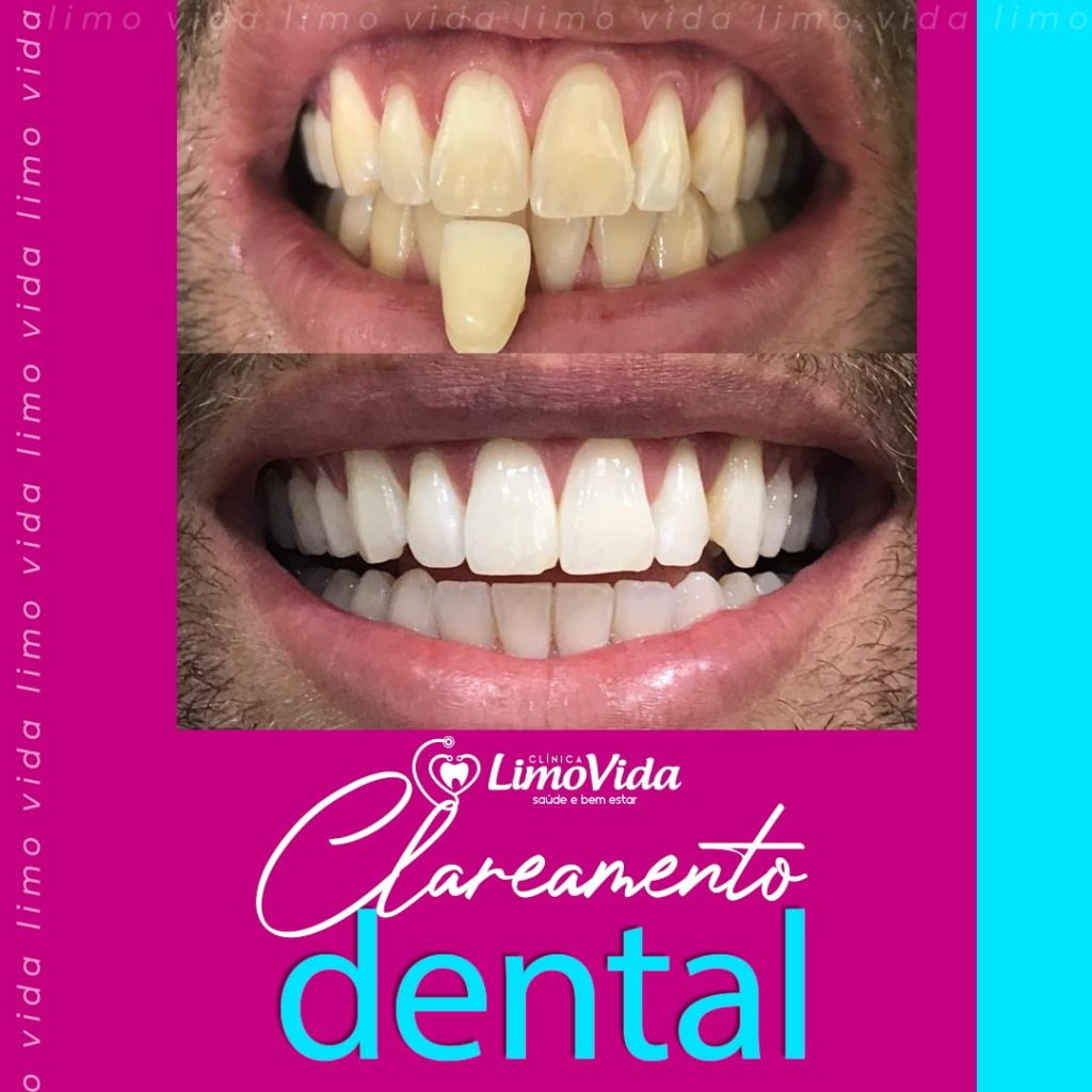 CLAREAMENTO DENTAL LIMOVIDA LIMOEIRO