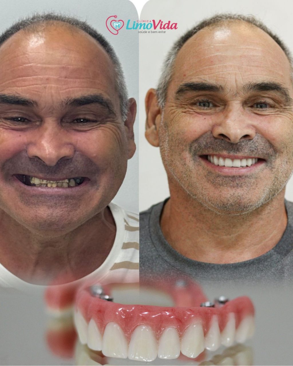 IMPLANTE PROTESE PROTOCO 09.2025 IMPLANTE PROTESE PROTOCO 09.2025