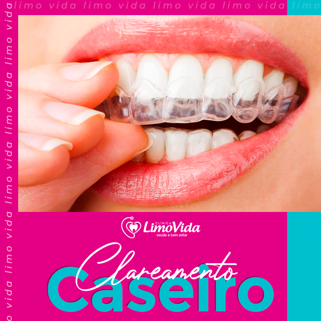 clareamento-caseiro 01 clareamento-caseiro 01