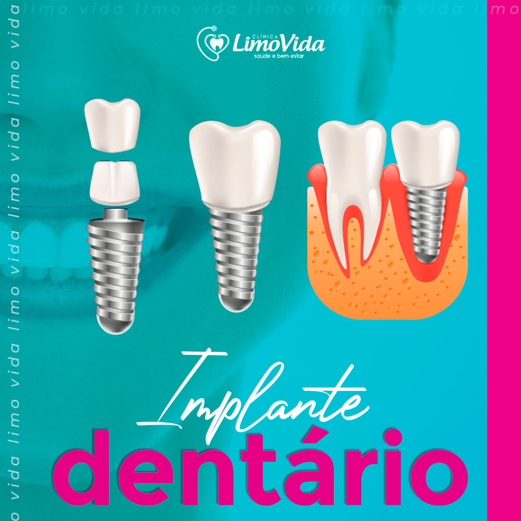 implante 01 implante 01