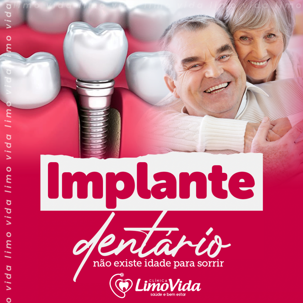 implante Dentário 02 implante Dentário 02